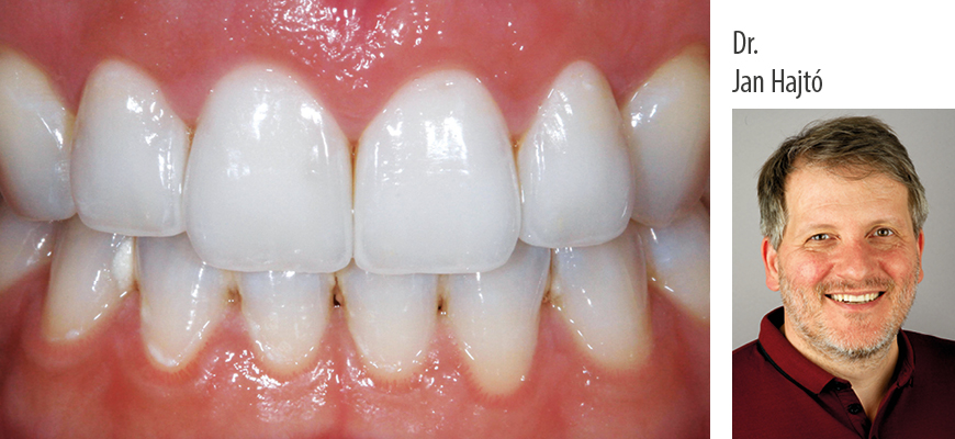Functional and Esthetic Anterior Laminate Veneers – Theory and Clinical Application