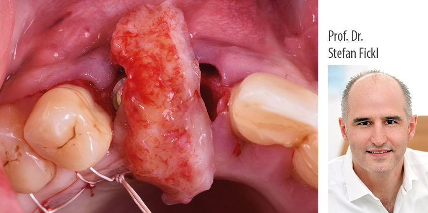 Weichgewebsmanagement um Implantate – wann, was, wie?