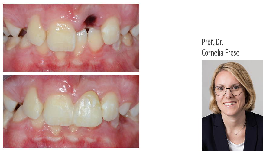 Faserverstärkte Komposite in der Zahnheilkunde – Einzelzahnersatz und postendodontische Versorgung tief zerstörter Zähne