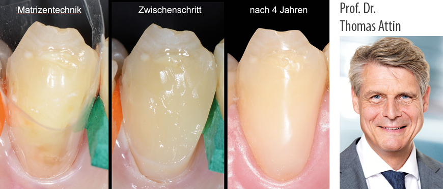 Zahnhalsläsionen – Praxiserprobte Tipps & Tricks zur Versorgung und Prävention