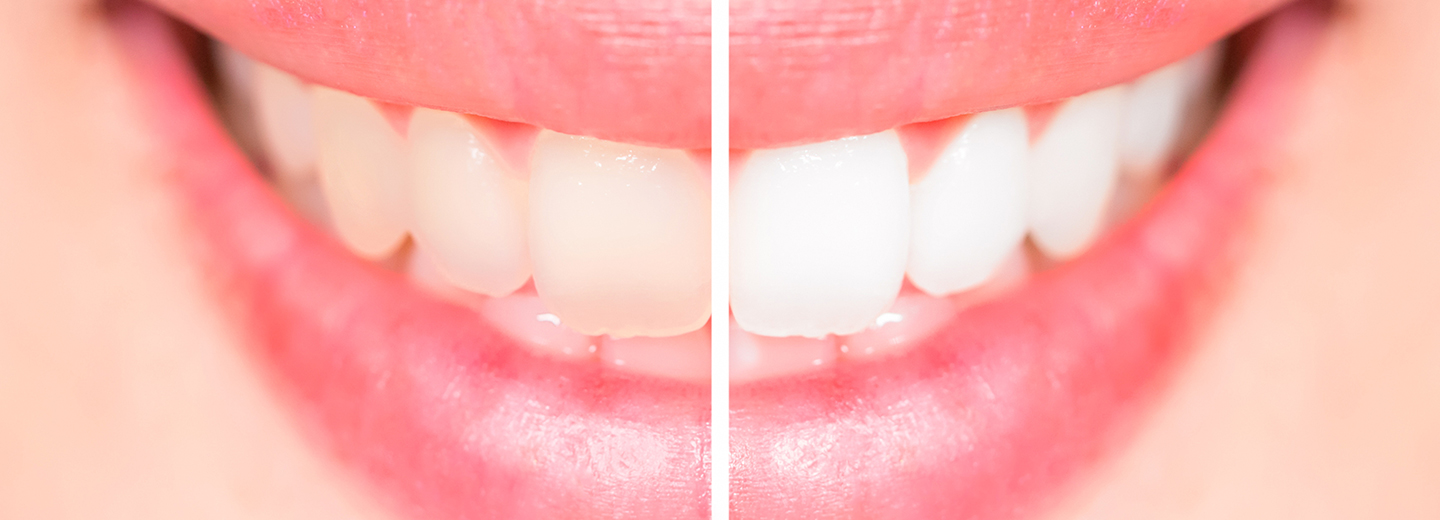 Bleaching A-Z